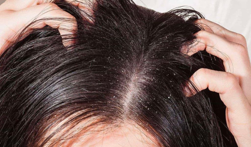 Dầu dừa giúp trị gàu hiệu quả