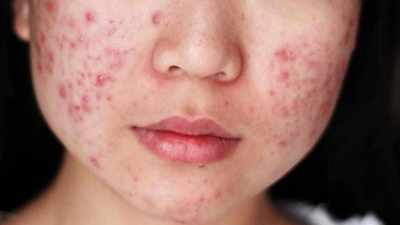 Dùng dầu dừa để trị mụn